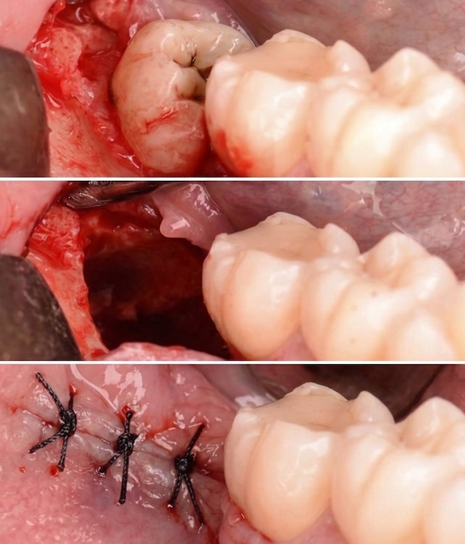 Cirugía Oral