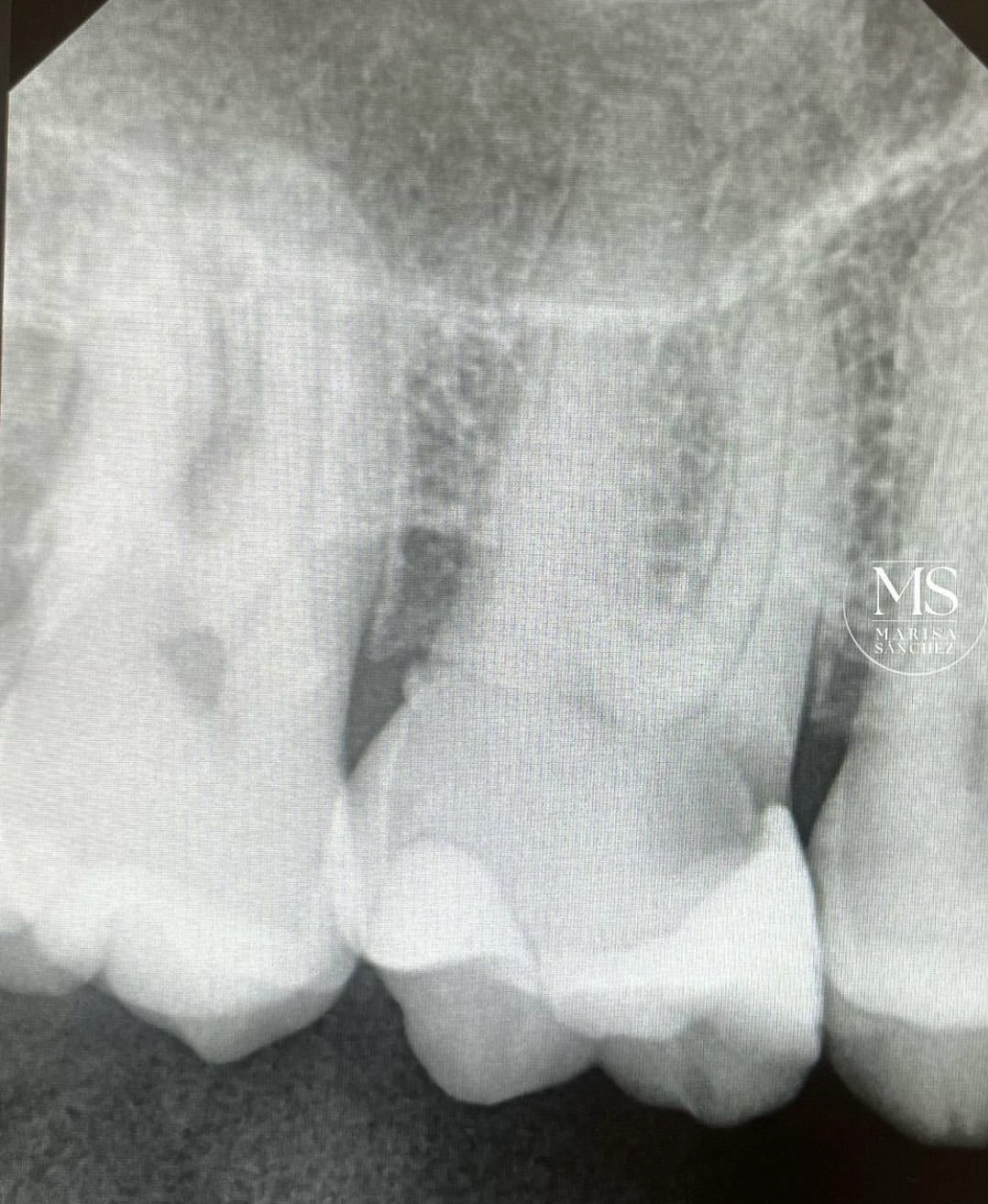 Endodoncia