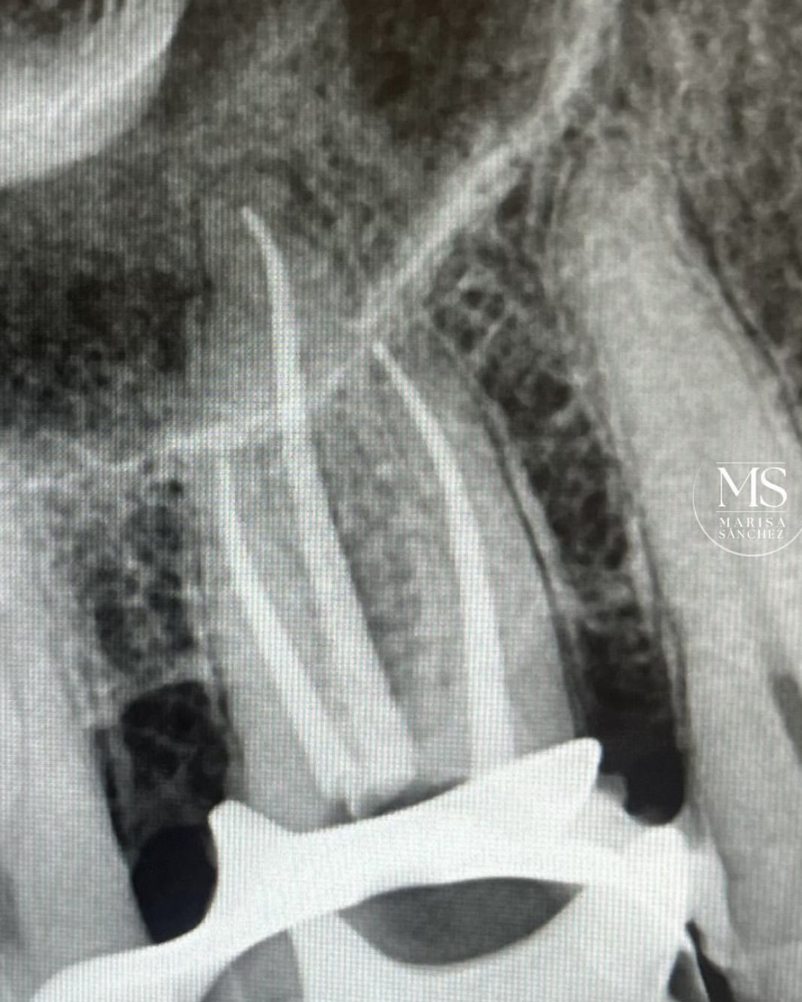 Endodoncia después