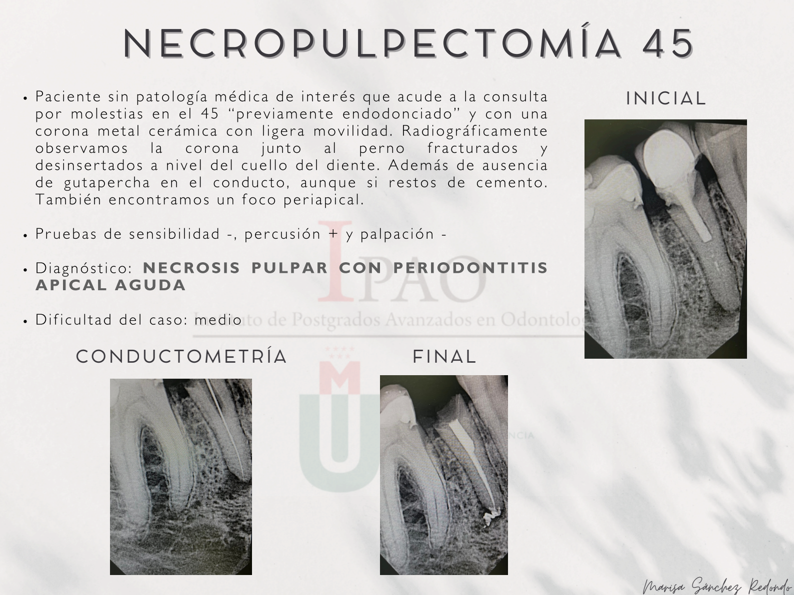 Endodoncia