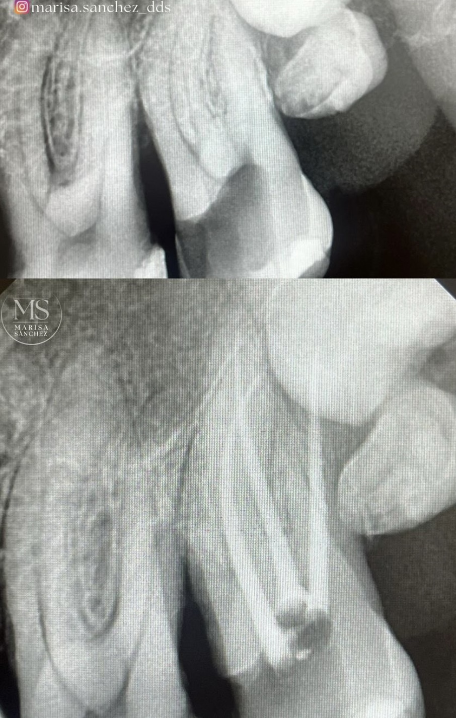 Endodoncia caso 3