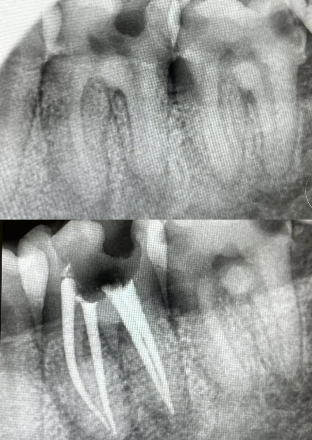 Endodoncia caso 4