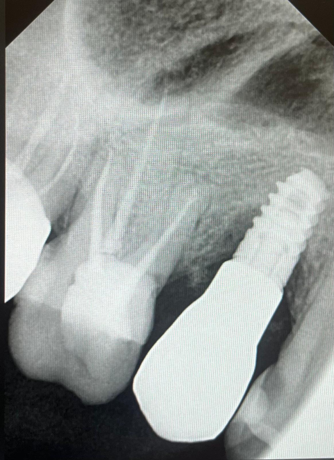 Endodoncia caso 5